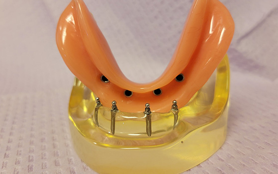 Racine Implants Dentist